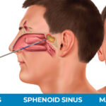 What is Balloon Sinuplasty?